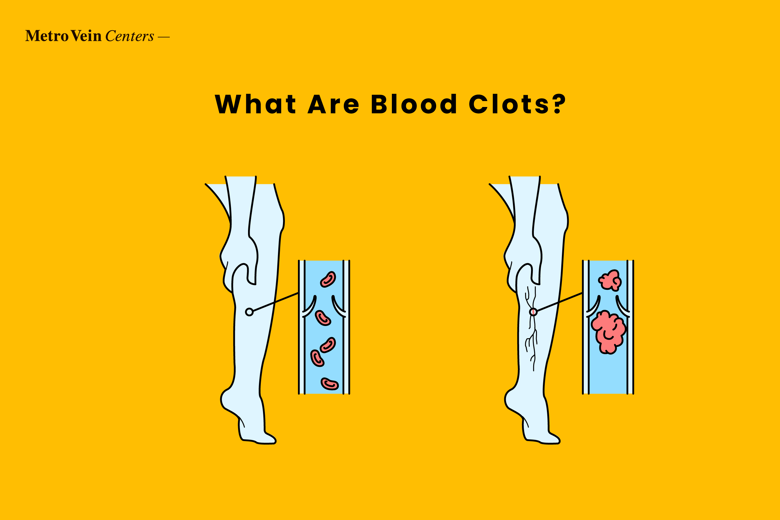 Learn how to identify blood clots in your ankles, feet, and legs with detailed pictures. Discover symptoms, diagnosis, and treatment options for safer legs.