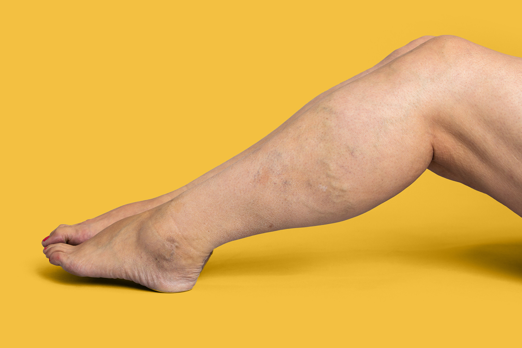 Discover the CEAP classification system for venous health, a globally recognized tool that helps diagnose and treat chronic venous disorders. Learn how this roadmap empowers patients and healthcare providers to address vein issues, from spider veins to active ulcers, with precision and care.