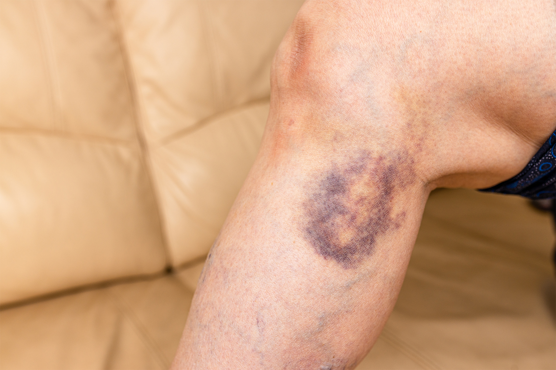 Learn how to manage common side effects of vein treatments effectively. Discover expert tips for a smooth recovery and optimal results from your vein procedure.