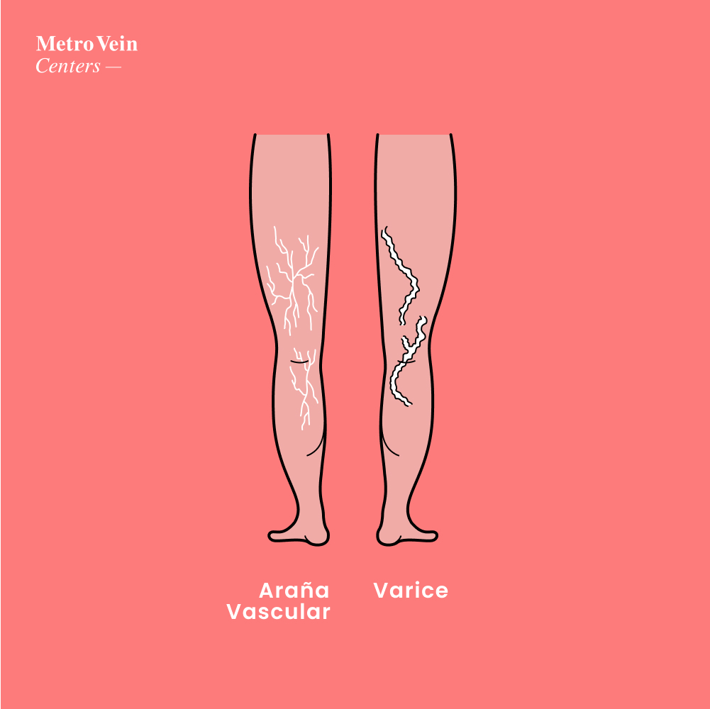 ¿Es la escleroterapia adecuada para tus venas? Descubre 4 cosas esenciales: duración, efectos secundarios, recuperación y resultados reales. ¡Infórmate en Metro Vein Centers!