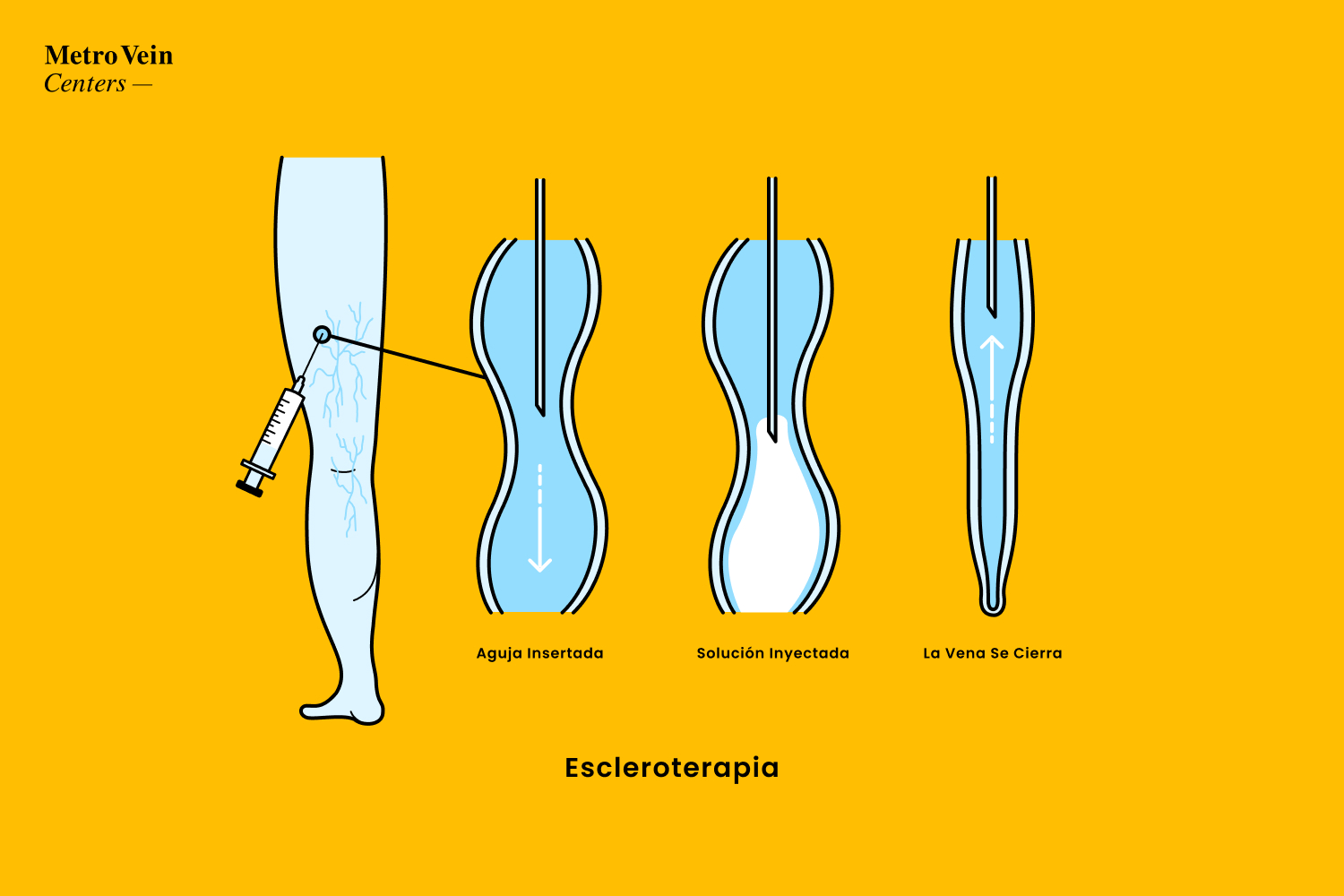 ¿Es la escleroterapia adecuada para tus venas? Descubre 4 cosas esenciales: duración, efectos secundarios, recuperación y resultados reales. ¡Infórmate en Metro Vein Centers!