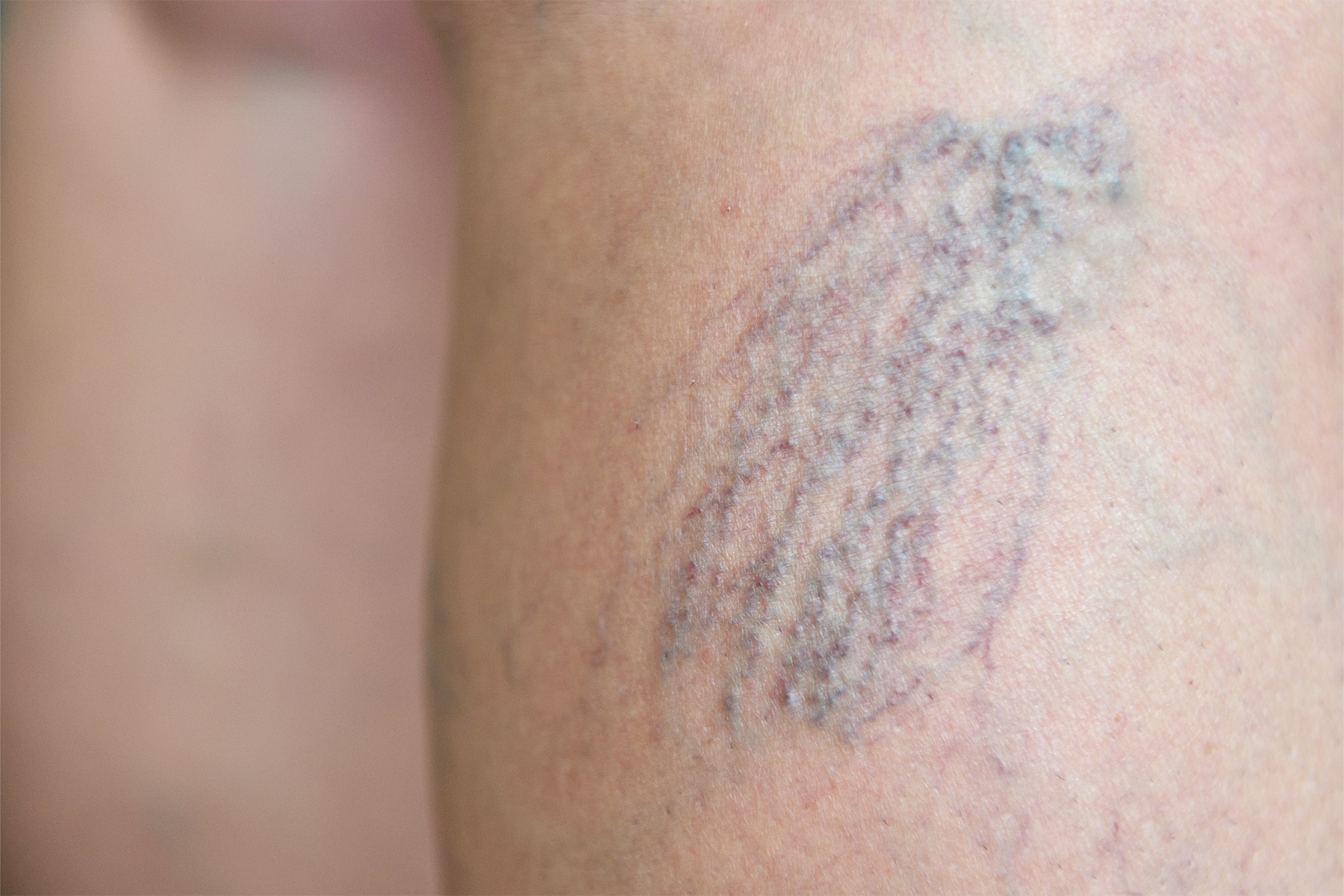 Descubra consejos de expertos para mantener las venas de las piernas sanas, prevenir las venas varicosas y conocer opciones de tratamiento diseñadas específicamente para la salud vascular de las mujeres.