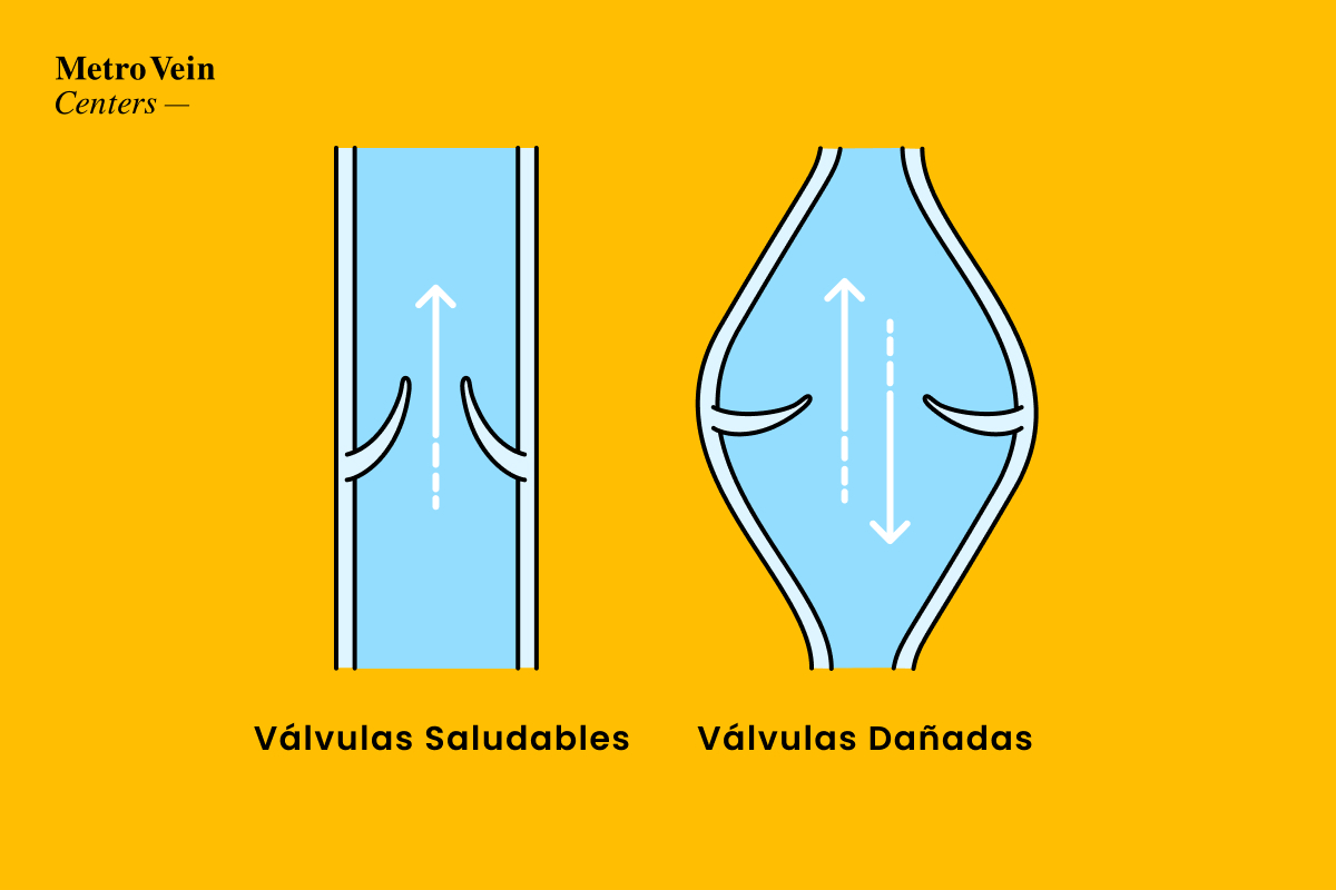 weak valves healthy valves in veins of leg graph