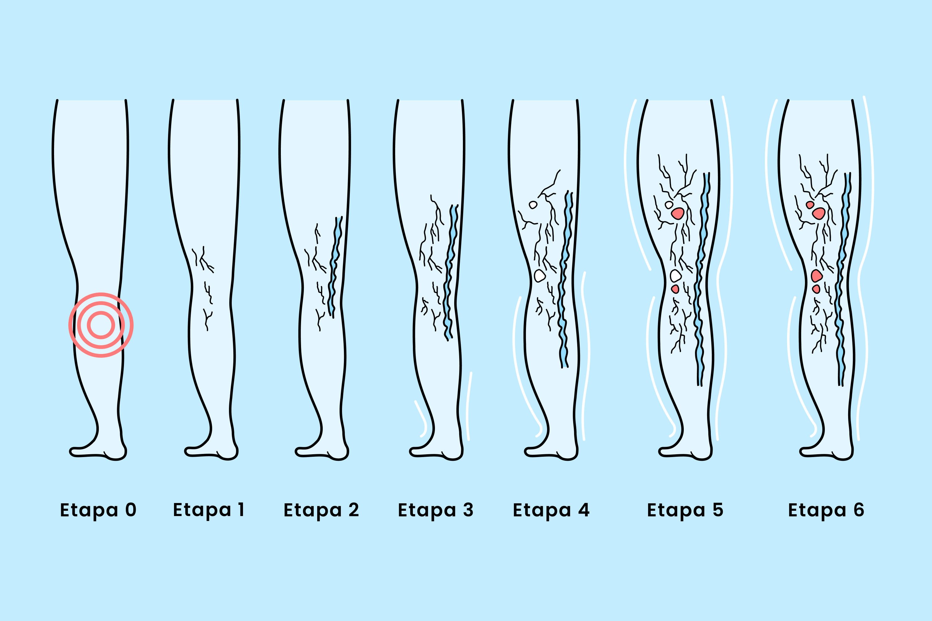 Conozca las etapas clínicas de las venas varicosas, desde las arañas vasculares tempranas hasta las úlceras venosas avanzadas, además de las opciones de tratamiento para cada etapa y las estrategias de prevención para unas piernas más saludables.